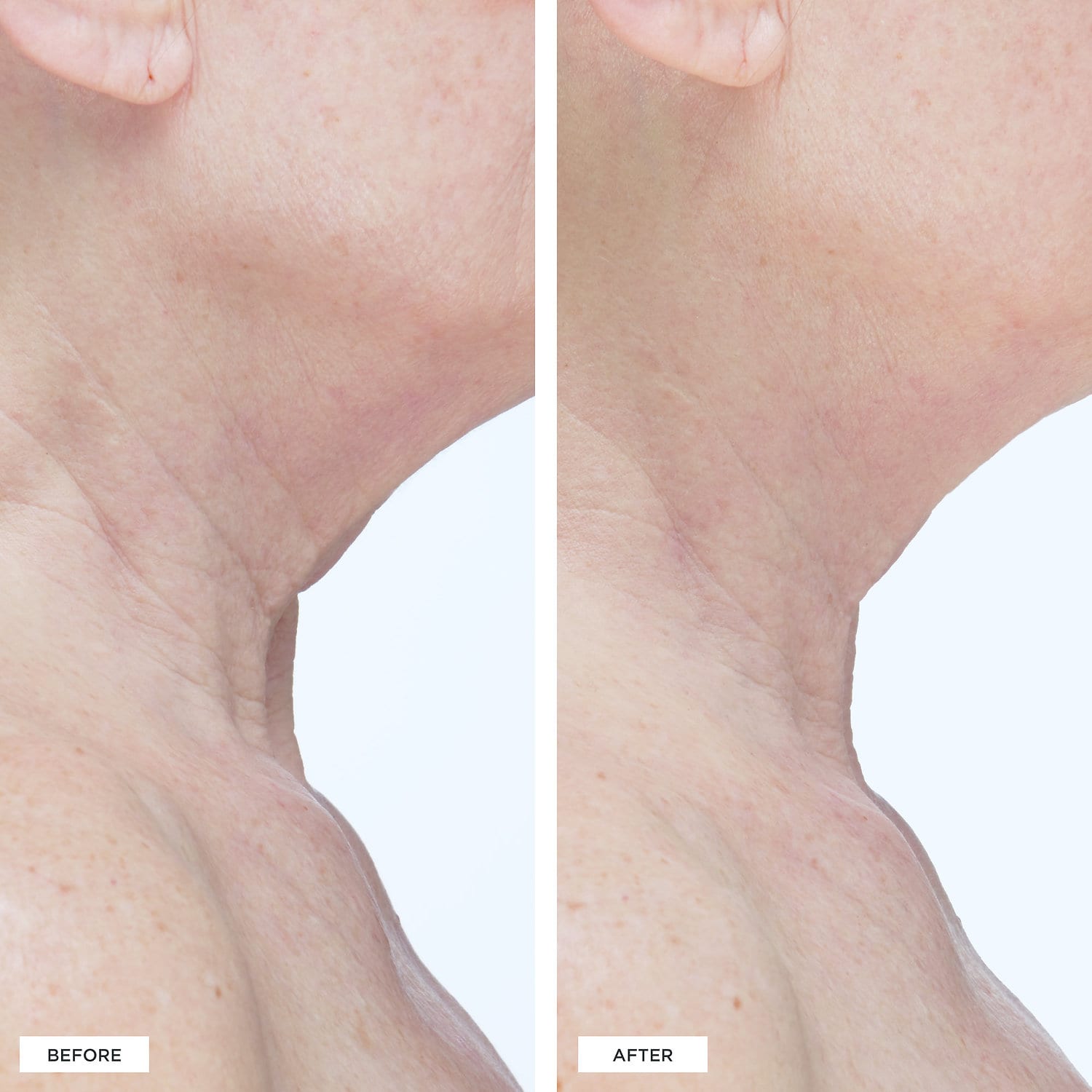 PERRICONE MD Cold Plasma Sub-D Firming Neck Treatment