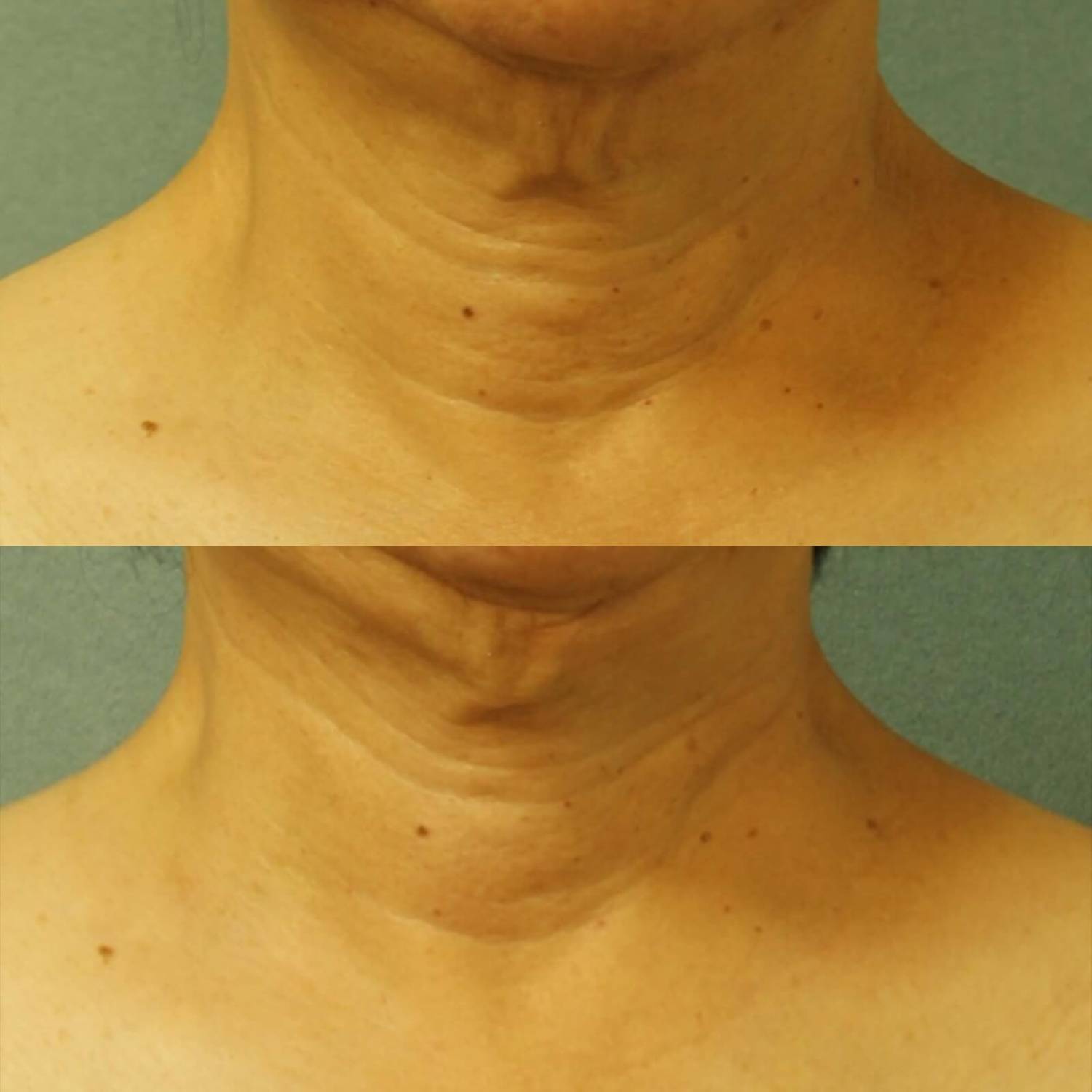 PERRICONE MD Cold Plasma Plus+ Neck & Chest Broad Spectrum Spf 25 купить в Beauty Storage. Быстрая доставка по России и СНГ.