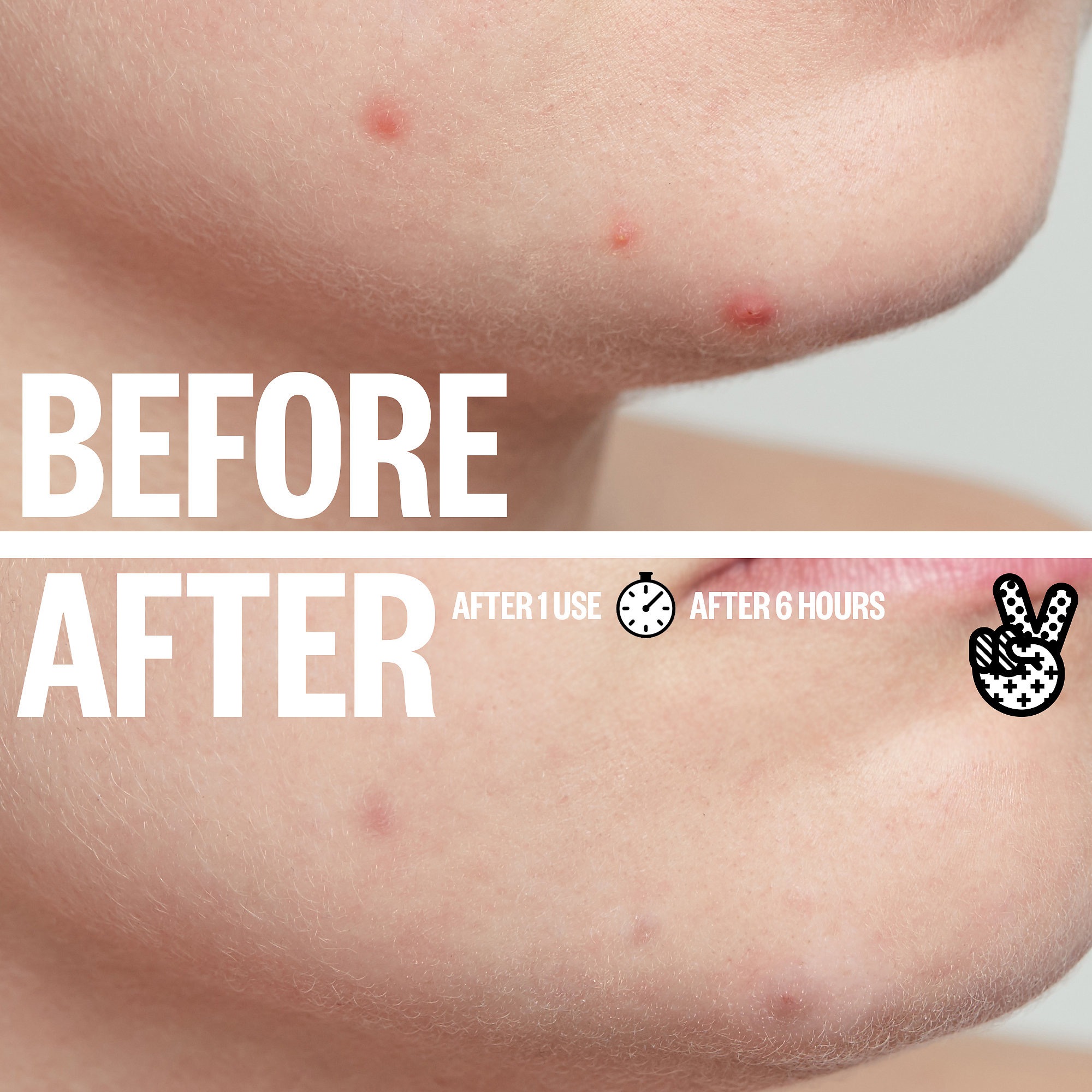 PEACE OUT Acne Healing Dots