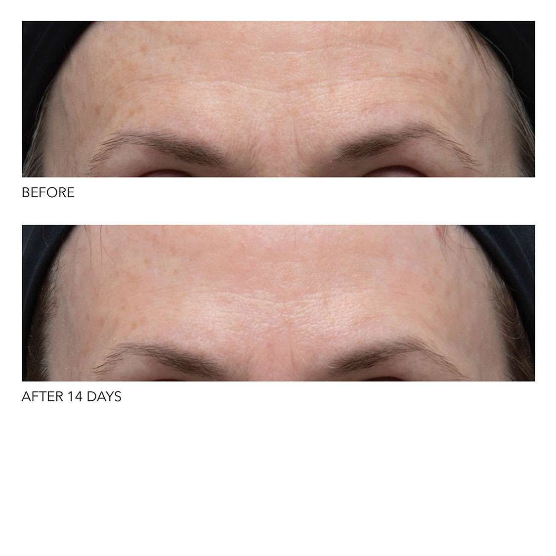 DR. DENNIS GROSS SKINCARE Ferulic + Retinol Wrinkle Recovery Peel