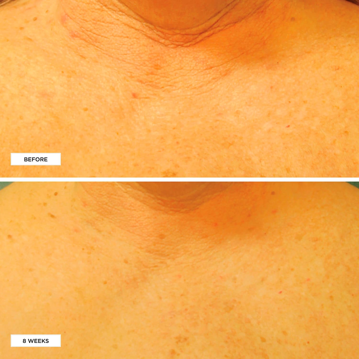 PERRICONE MD Cold Plasma Plus+ Neck & Chest Broad Spectrum SPF 25